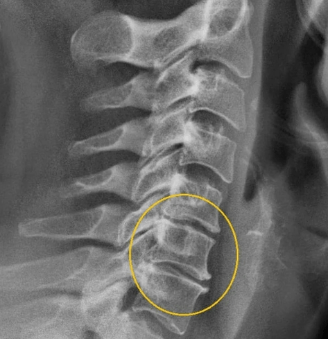 cervikalna osteohondroza